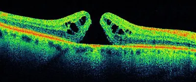 OCT koherentna tomografia siatkówki Inowrocław